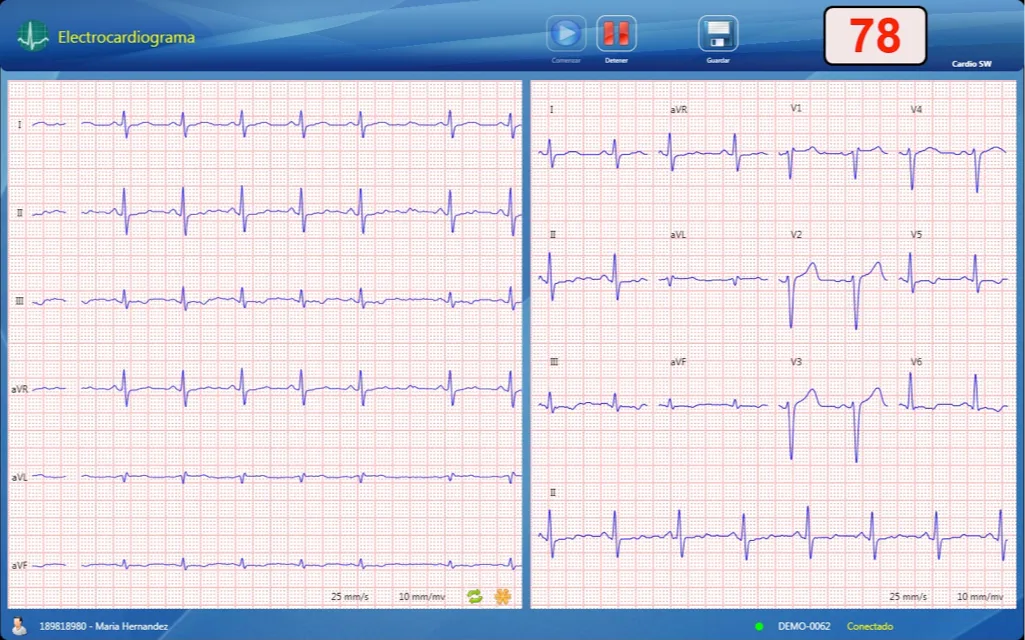 Programa CardioSW Rest ECG tomando un ECG de 12 derivaciones en tiempo real con frecuencia de 78 lpm