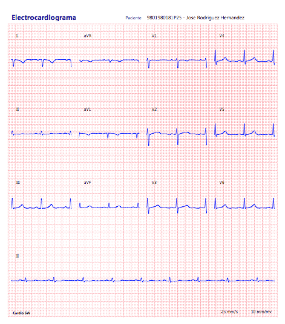 Informe de electrocardiograma en reposo generado por CardioSW con las 12 derivaciones y tira larga de DII
