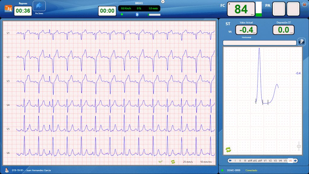 Programa CardioSW Stress Test monitoreando derivaciones precordiales y el segmento ST bajo protocolo Bruce