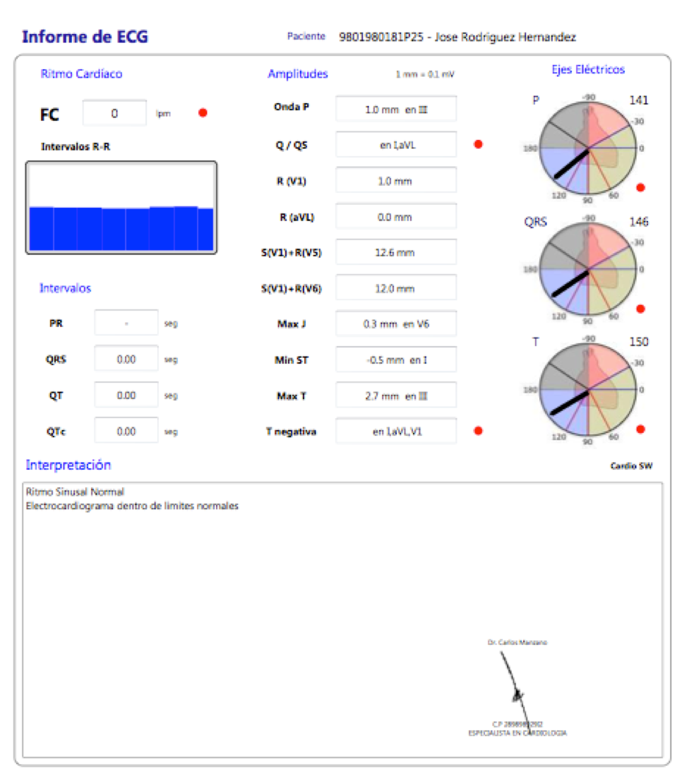 Informe de ECG de CardioSW con ritmo cardiaco, intervalos, amplitudes, ejes eléctricos e interpretación
